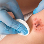 Inmunonutrición promueve el cierre de heridas en pacientes con úlceras en la piel